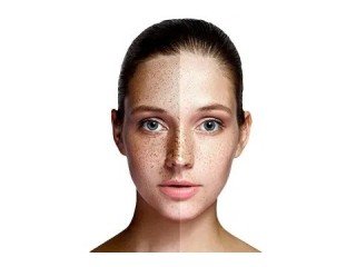 Skin pigmentation treatment