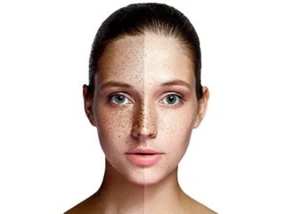 skin-pigmentation-treatment