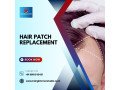 hair-patch-repair-replacement-center-in-bangalore-hair-glimmer-small-2