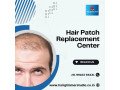 hair-patch-repair-replacement-center-in-bangalore-hair-glimmer-small-1